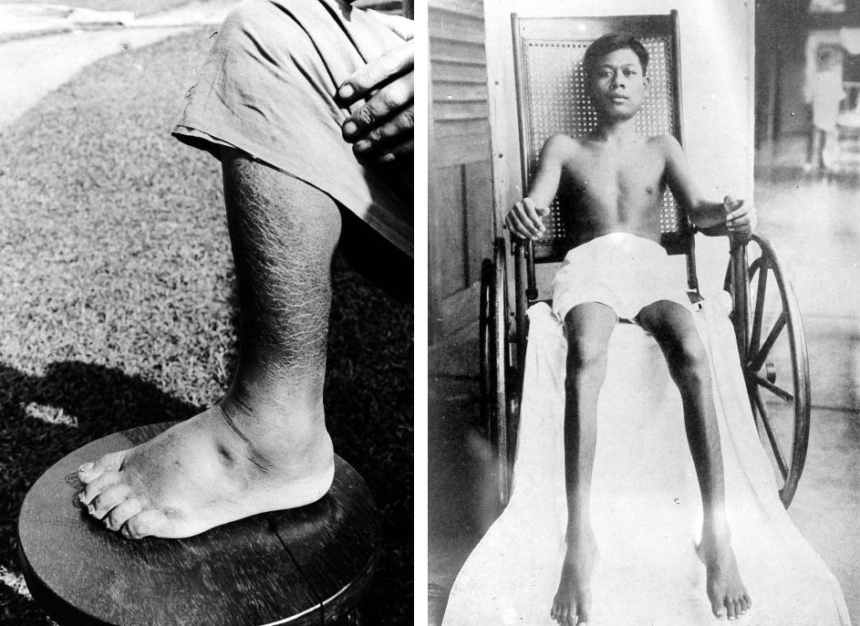 2-panel image of black and white photographs showing symptoms of beriberi. Panel 1: Photograph of a person's leg and foot, with the foot resting on a wood table or stool. Both the leg and especially the foot appear swollen. Panel 2: Photograph of a man sitting in a wheelchair. The man is facing the viewer and appears to be wearing white shorts. His legs are resting on a white cloth and appear thin.