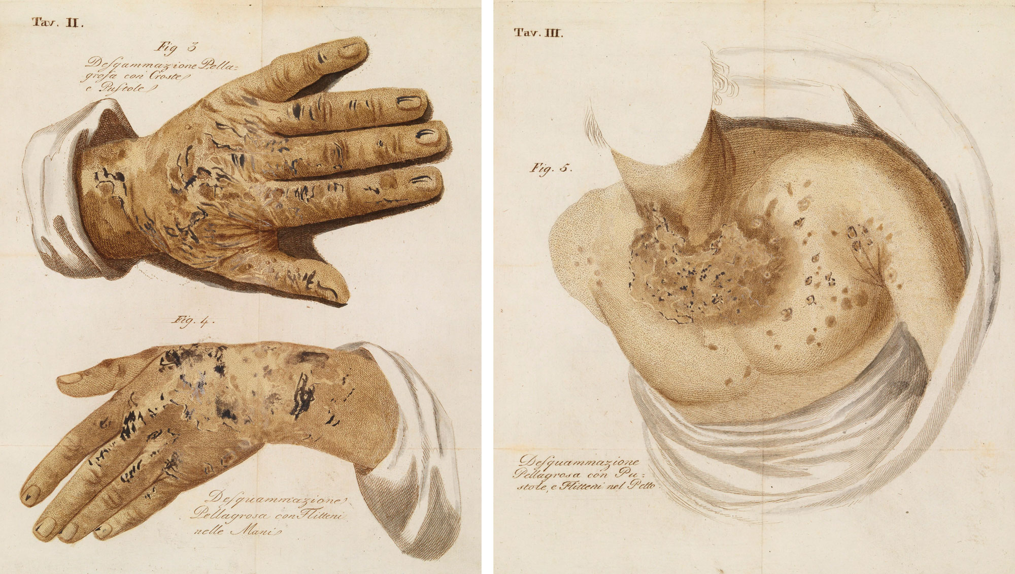 Two-panel image showing plates illustrating pellagra symptoms from a book published in 1814. Panel 1: Illustrations of two hands showing skin with rashes or plaques. Panel 2: Image of a person's neck and chest showing spotting, particularly on the lower neck and upper chest, indicating pellagra.
